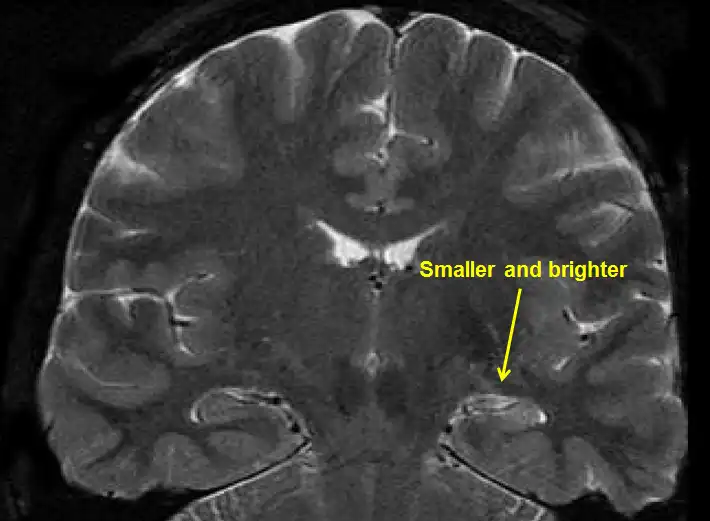 Apakah Epilepsi Lobus Temporal Bisa Disembuhkan? Simak Opsi Terapi dan Penanganannya