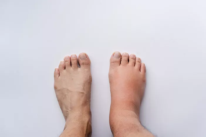 Kaki Bengkak Bukan Sekadar Capek, Simak Fakta Medisnya
