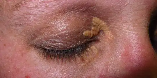 Waspada Tanda Kuning di Kelopak Mata, Isyarat Bahaya Kolesterol Tinggi