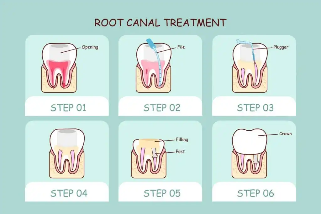 Jangan Cabut Gigimu! Kenali Perawatan Saluran Akar (Root Canal) yang Tak Seseram Mitosnya