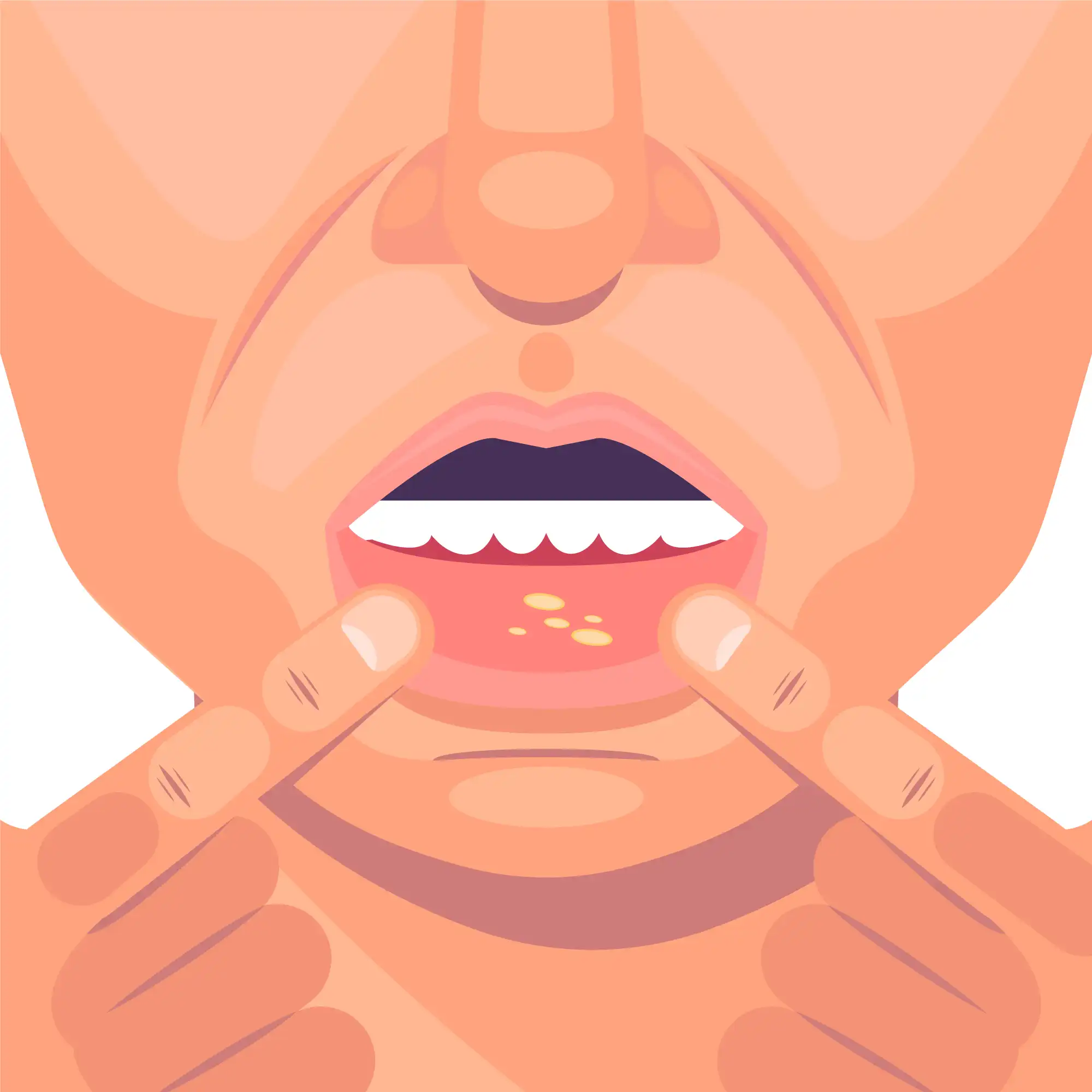 Benarkah Garam Bisa Menyembuhkan Sariawan dan Cara Tepat Menggunakannya