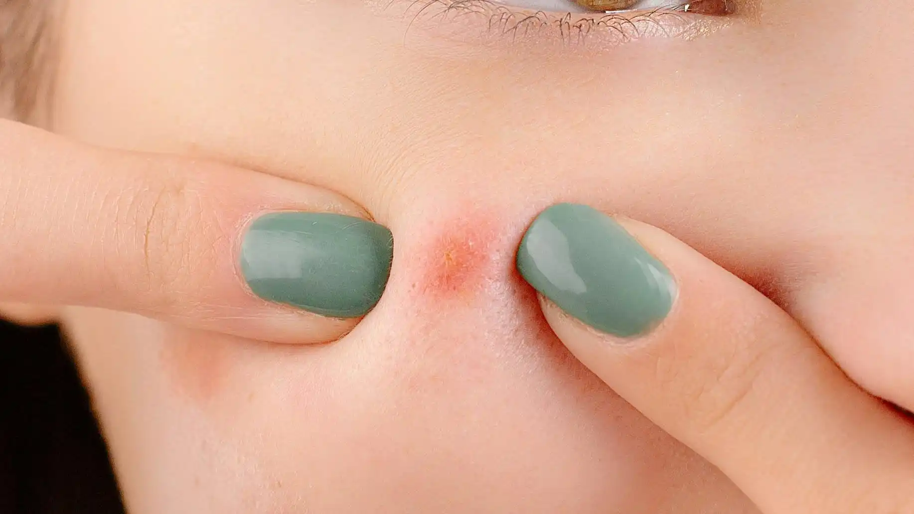 Sering Oles Odol ke Jerawat? Kenali Risikonya Sebelum Terlambat