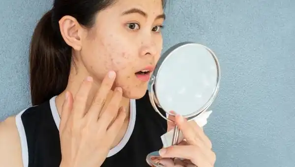 Skincare Mahal Tak Mempan? Ini Cara Jitu Atasi Jerawat