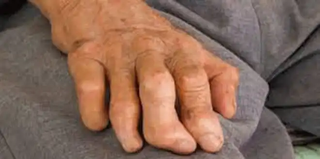 Dinkes Sumut Catat 122 Kasus Baru Kusta Sepanjang 2025, Seluruh Pasien Dapat Terapi Gratis