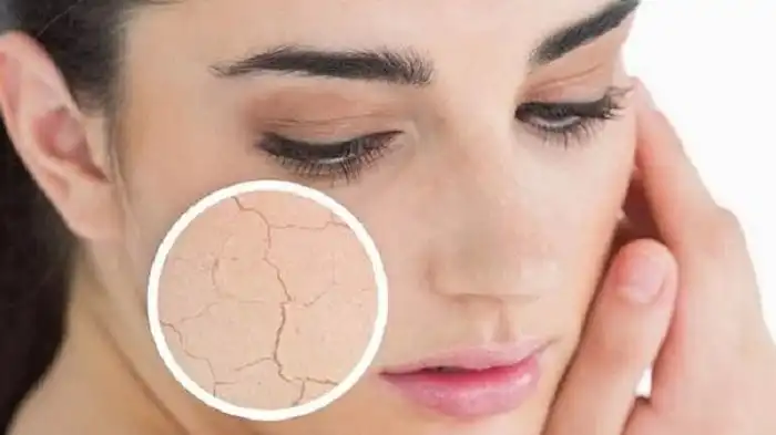 Penyebab, Dampak, dan Cara Merawat Kulit Kering  dengan Tepat