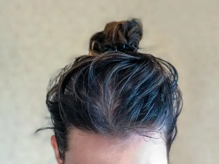 Mengapa Rambut Terasa Lebih Berminyak Saat Cuaca Panas? Ini Penjelasan Penyebabnya