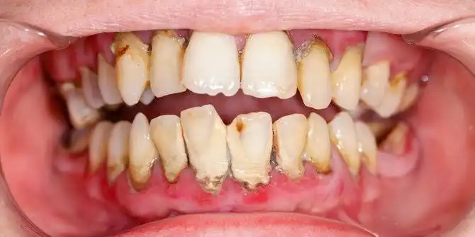 Kenapa Karang Gigi Bisa Sangat Keras dan Menumpuk? Ini Penjelasan Ilmiahnya