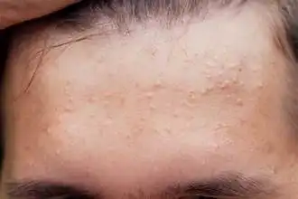 Wajah Gradakan? Kenali Penyebab Beruntusan dan Cara Mengatasinya