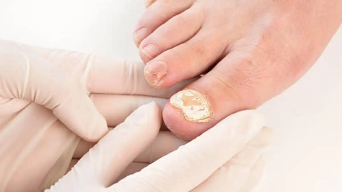 Cara Mengatasi Jamur Kaki (Tinea Pedis): Penyebab, Gejala, dan Pengobatan yang Efektif