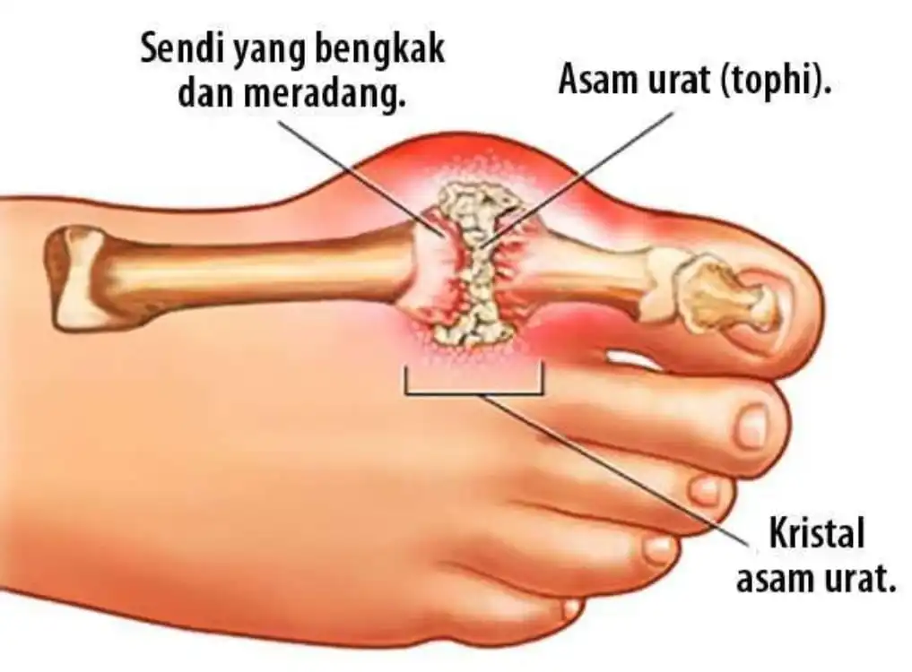 Asam Urat: Penyebab, Gejala, dan Cara Mengelola Kesehatan Sendi