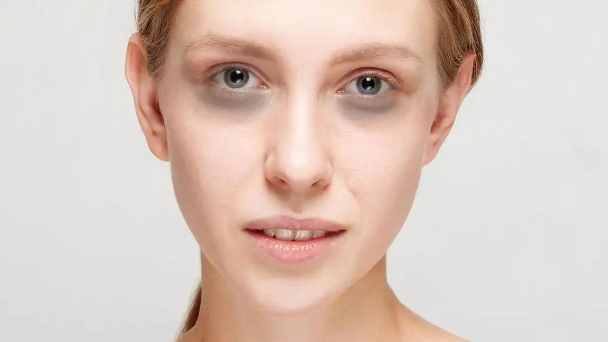 Bye-bye Mata Panda! Cara Alami Hilangkan Lingkaran Hitam Tanpa Skincare Mahal
