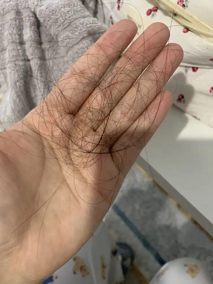 Rambut Rontok: Penyebab, Cara Mengatasi, dan Kapan Harus Waspada