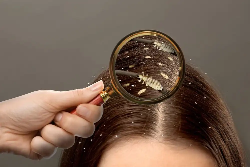Solusi Praktis Basmi Kutu Rambut Agar Nongkrong Nyaman