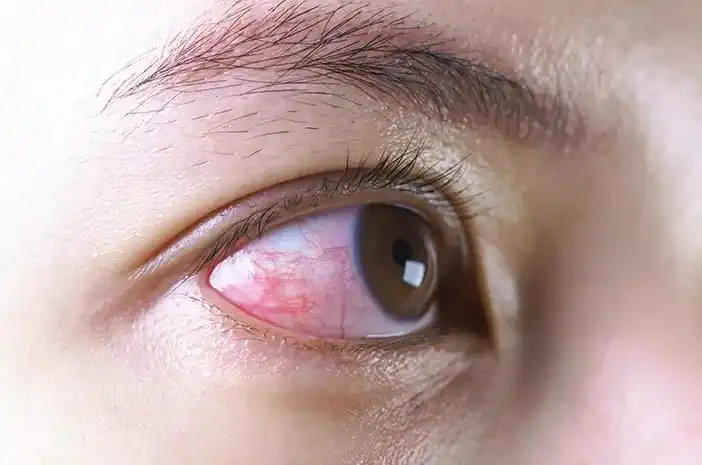 kenapa mata jika terkena sabun rasanya perih bahkan bisa sampai merah , tapi jika terkena kulit tidak terasa apa apa kok bisa?