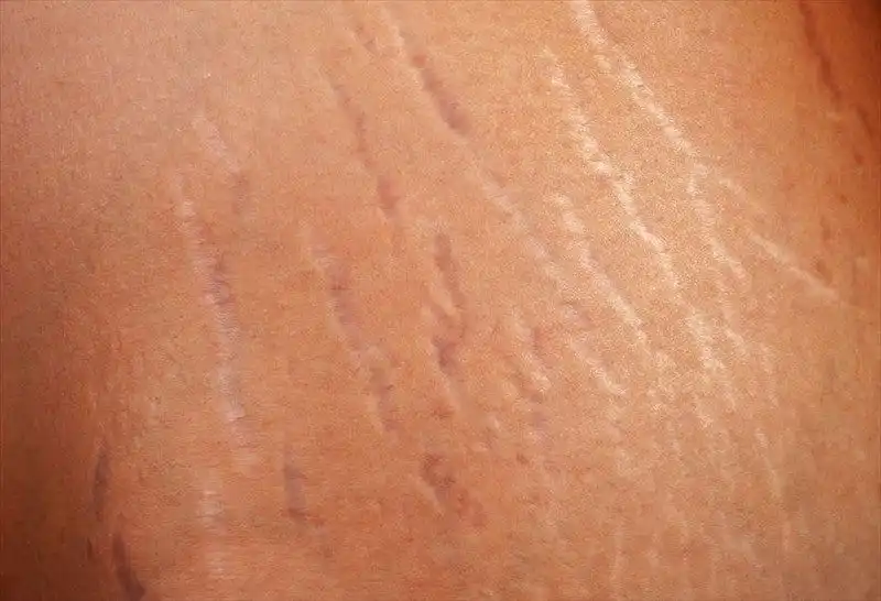 Cara Menghilangkan Stretch Mark di Perut: Tips Alami hingga Perawatan Medis