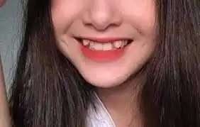 Alasan Kenapa Gigi Gingsul Bikin Senyum Makin Manis