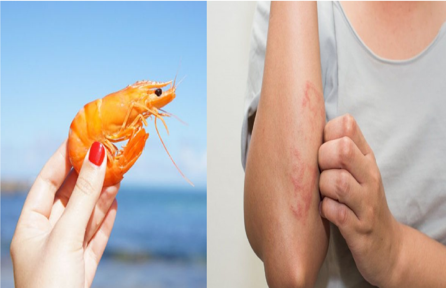 Kenapa Sih Udang yang Enak Itu Bisa Bikin Kulit Kita Ngamuk?