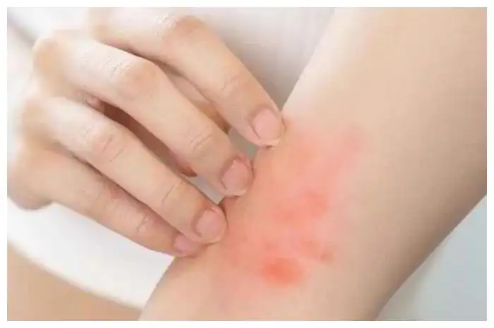 Biduran Datang Tiba-Tiba? Ini Kandungan Obat yang Biasanya Disarankan Dokter