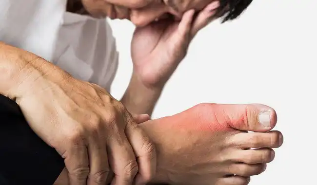 Jangan Salah Sangka, Asam Urat Bukan Cuma Penyakit Orang Tua: Anak Muda Juga Bisa Kena