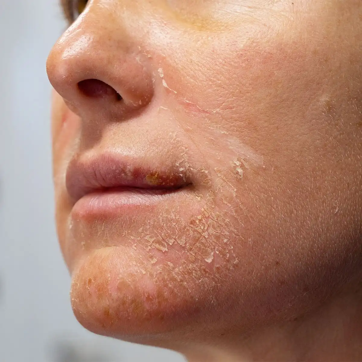 Sering Menemukan Kerak di Sekitar Hidung dan Mulut? Ini Penyebab yang Mungkin Terjadi