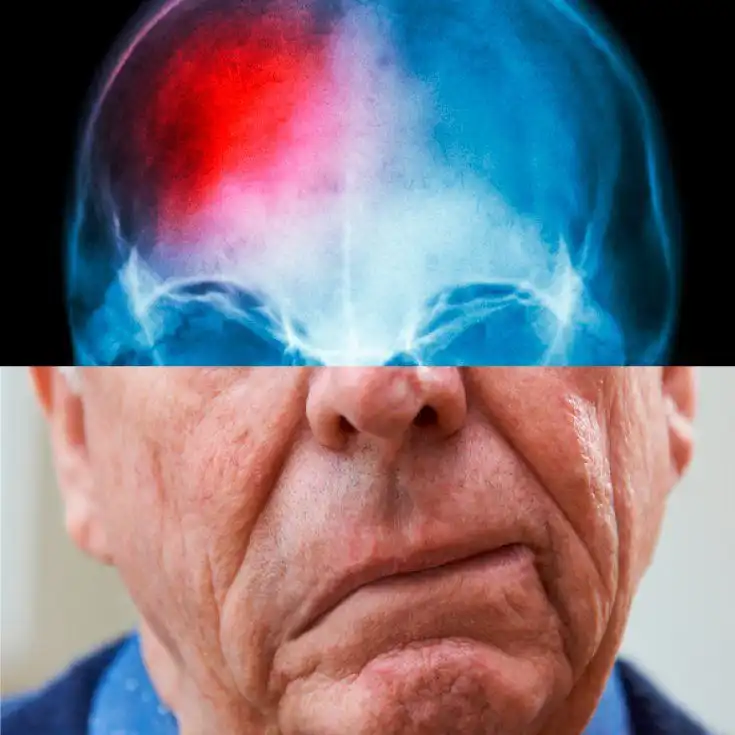 Mengenali Gejala Awal Stroke yang Wajib Diwaspadai