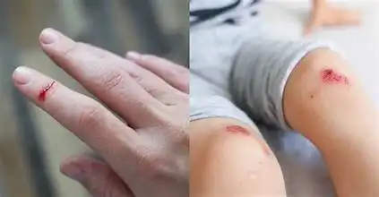 Mengapa Luka Kecil Bisa Terasa Perih? Ini Alasan di Balik Rasa Sakitnya
