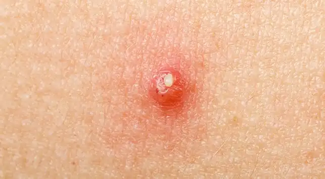 Bisul Tiba-tiba Muncul? Hindari 5 Kebiasaan Ini agar Tidak Semakin Parah