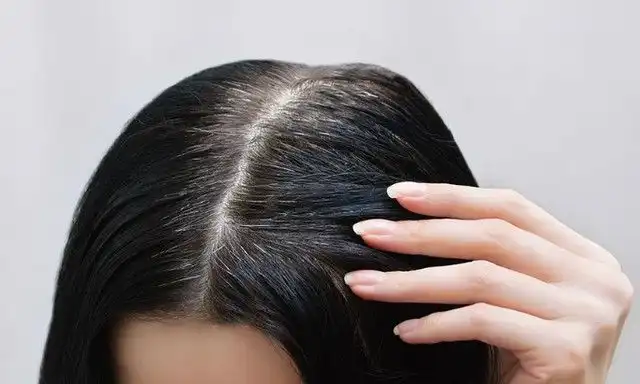 Penyebab Uban di Usia Muda: Genetik, Stres, hingga Kekurangan Vitamin B12