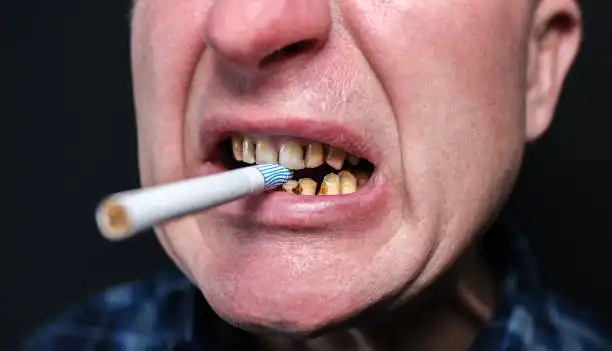 Dampak Rokok pada Gigi dan Mulut: Dari Gigi Kuning hingga Risiko Kanker Mulut