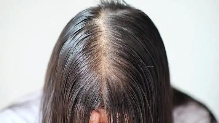Rambut di umur 20 tahunan sudah mulai menipis Apakah itu normal?