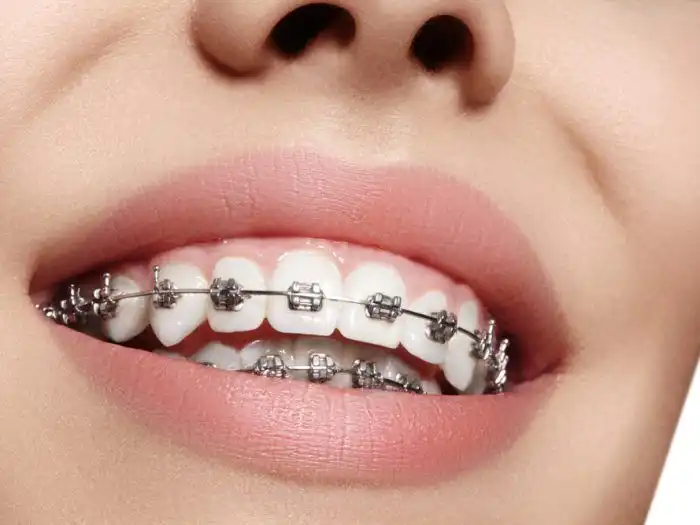 Dilema Behel Gigi: Antara Gaya, Rasa Sakit, dan Perjalanan Menuju Senyum Percaya Diri
