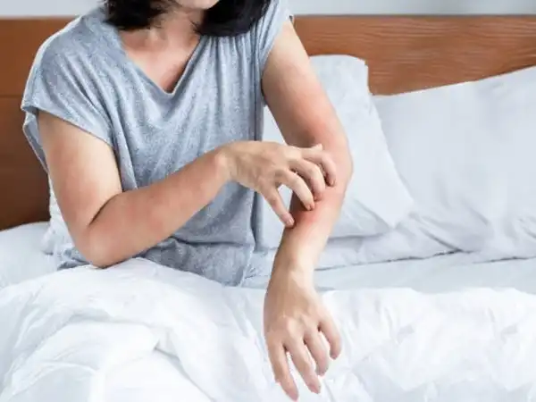 Sering Gatal Saat Tidur? Kenali Penyebab Gatal di Malam Hari