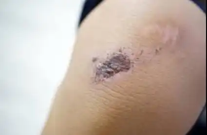 Sering Ngelupas Bekas Luka? Yuk Cari Tahu Penyebab Psikologisnya