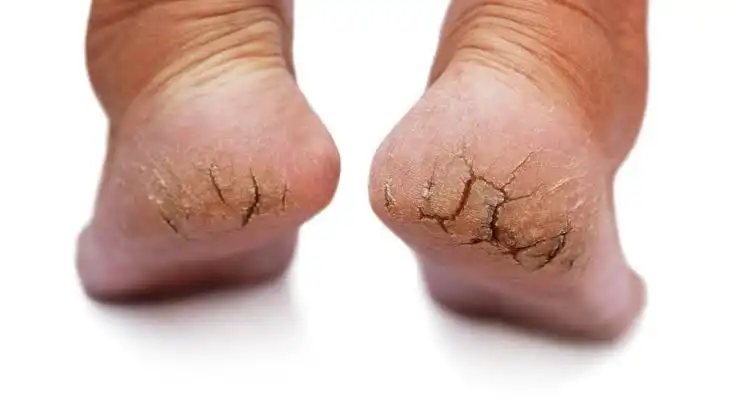 Mengapa tumit kaki sering sekali pecah-pecah dan berwarna hitam itu faktor apa??