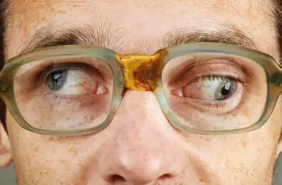 Mata Juling Bukan Takdir Permanen, Bisa Diperbaiki dengan Operasi Strabismus