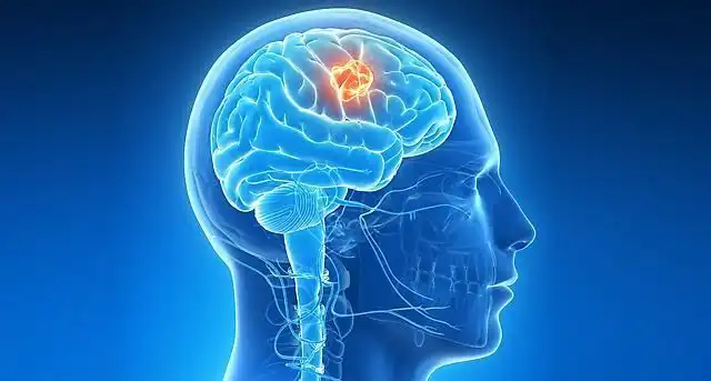 Sakit Kepala Biasa atau Tanda Serius? Mengenal Gejala Tumor Otak dengan Lebih Bijak