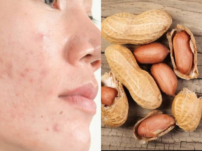 Mitos atau Fakta? Benarkah Makan Kacang Bisa Menyebabkan Jerawat