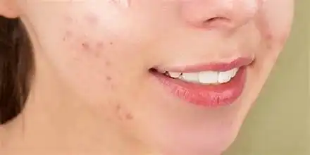 Musuh Bebuyutan Wajah Si Jerawat yang Bikin Emosi