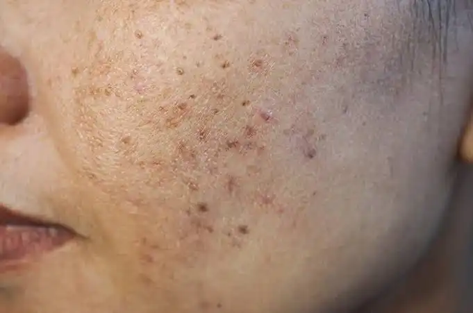 Bekas Cacar Berlubang Bikin Minder? Ini Cara Menghilangkannya!