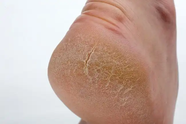 8 Cara Menghilangkan Kapalan di Kaki Secara Aman dan Efektif