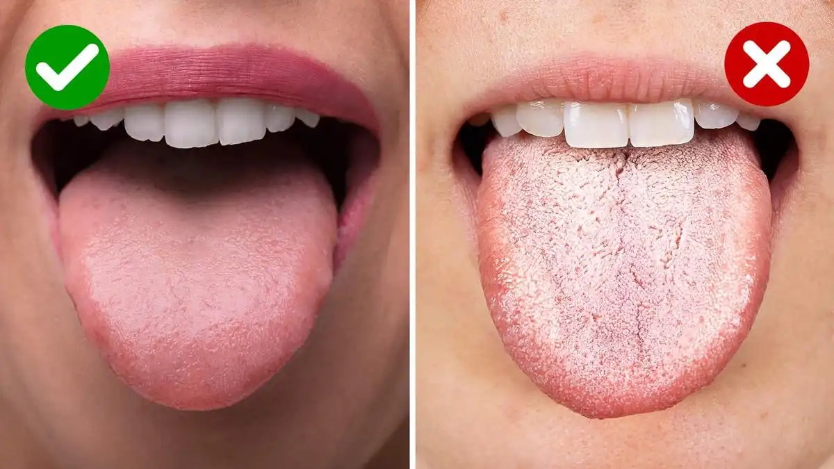 Kenapa Lidah Putih dan Rasa Makanan Hambar? Cek Faktanya di Sini