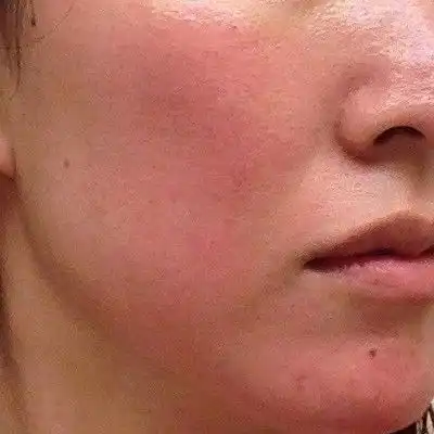 Tanda Kulit Mengalami Over-Exfoliation yang Jarang Disadari