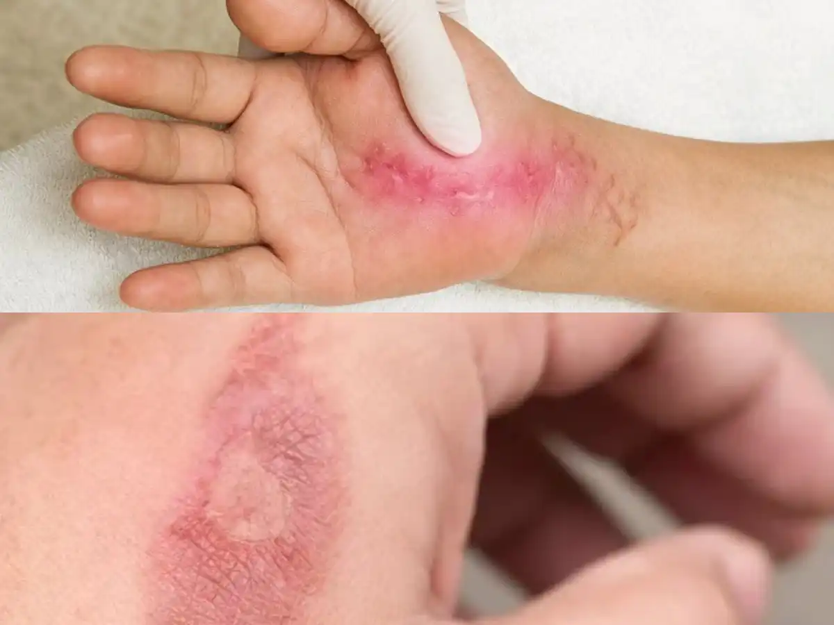 Mengapa Luka Bisa Gatal Saat Sembuh?