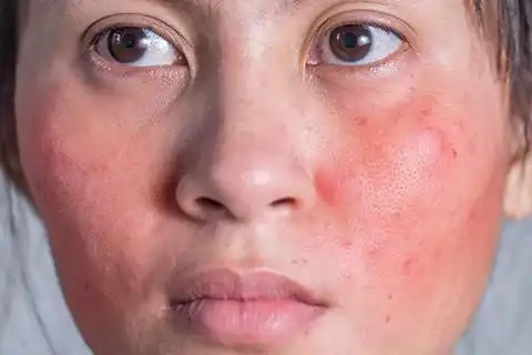 Bercak Merah di Muka Habis Skincare-an? Ini Tandanya Kulit Stres