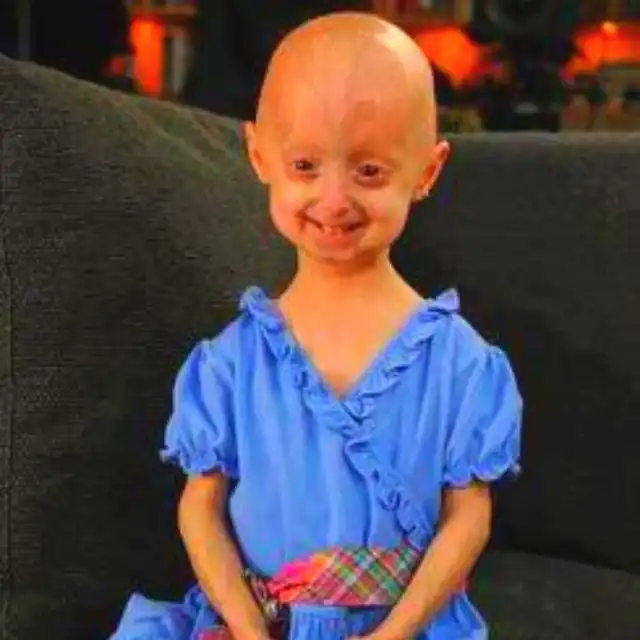 Progeria Membuat Tubuh Mengalami Penuaan Dini, Bagaimana Kondisi Ini Terjadi?