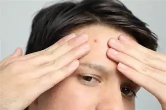 Jerawat di Dahi Sering Dikaitkan dengan Banyak Pikiran, Benarkah Stres Bisa Jadi Pemicu?