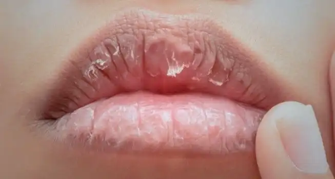 Kenapa Bibir Bisa Kering dan Pecah-Pecah? Ini Penyebab serta Cara Mengatasinya