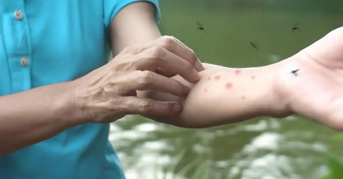 Mengenal Prurigo Istilah Medis untuk Si Pemilik Darah Manis