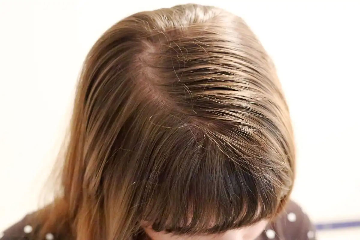 7 Penyebab Kulit Kepala Berminyak yang Bikin Rambut Cepat Lepek