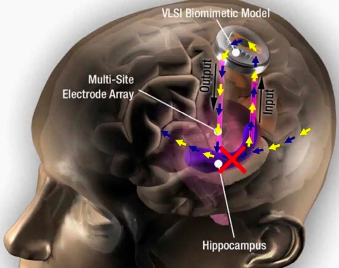 Chip Otak,Harapan Baru untuk Memulihkan Ingatan yang Hilang
